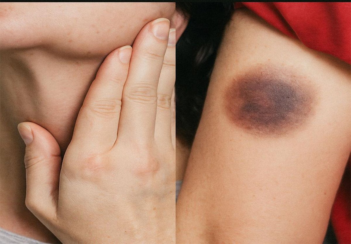 LEUCEMIA un tipo silencioso de cáncer que se manifiesta