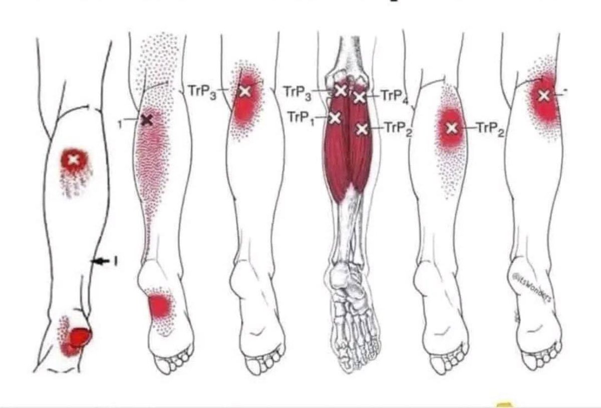 ¿Te duelen los músculos sin razón aparente? Podría ser fibromialgia