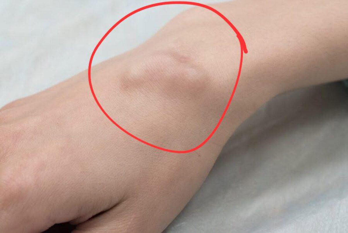 Tienes un bulto en la piel como identificarlo