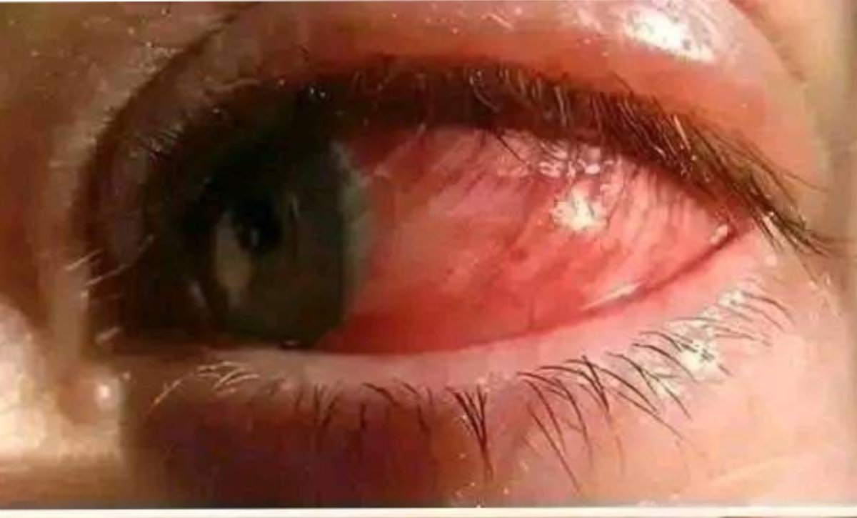 Ojos rojos al dormir: efectos que pueden ser dañinos para la vista