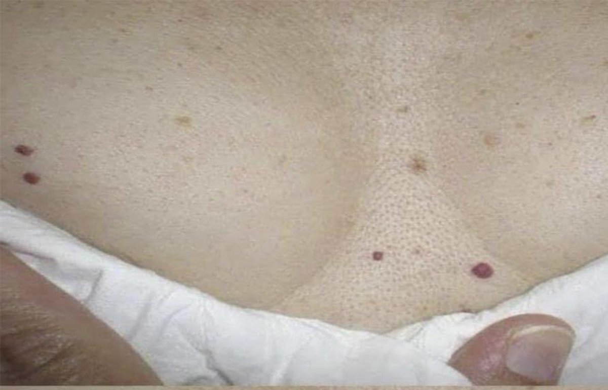 ¿Te han salido puntos rojos en la piel? Esto es lo que tu cuerpo podría estar tratando de decirte