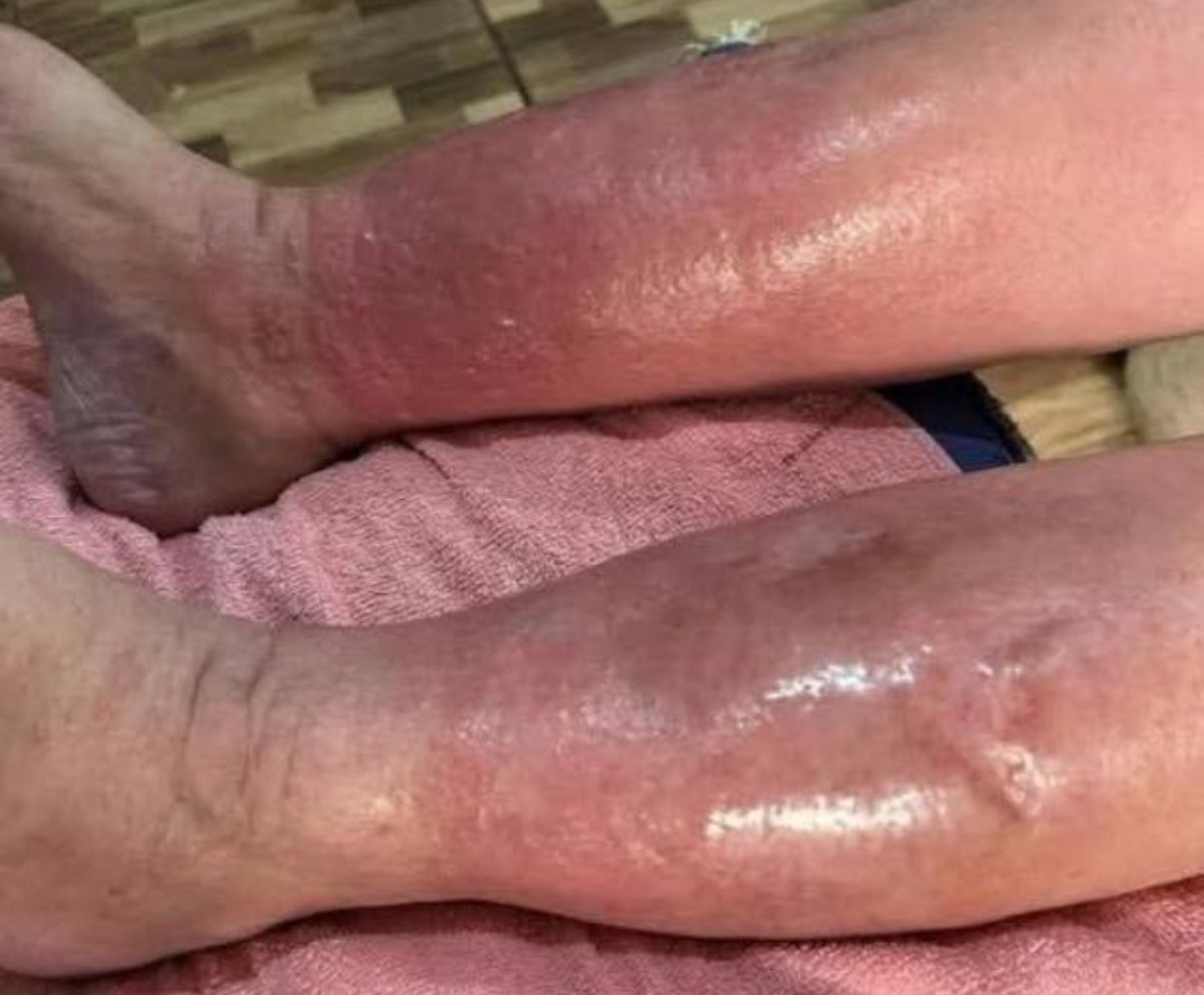 Señales en las Piernas que Podrían Indicar Diabetes o Azúcar Alta en la Sangre