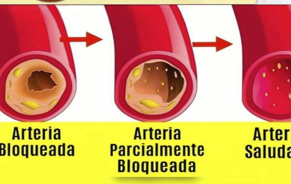 Recetas con Menta, Alcachofa, Ajo y Cúrcuma para Limpiar las Arterias
