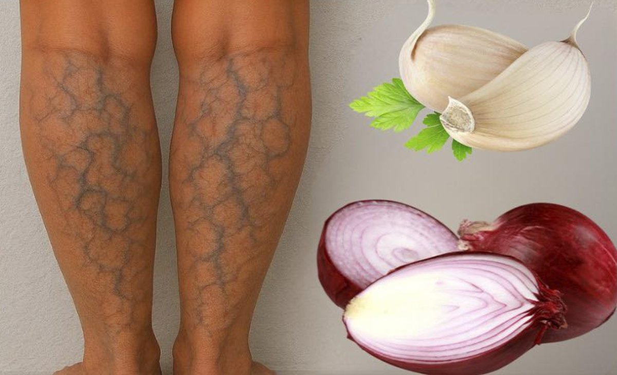 Remedios Caseros para las Várices con Cebolla