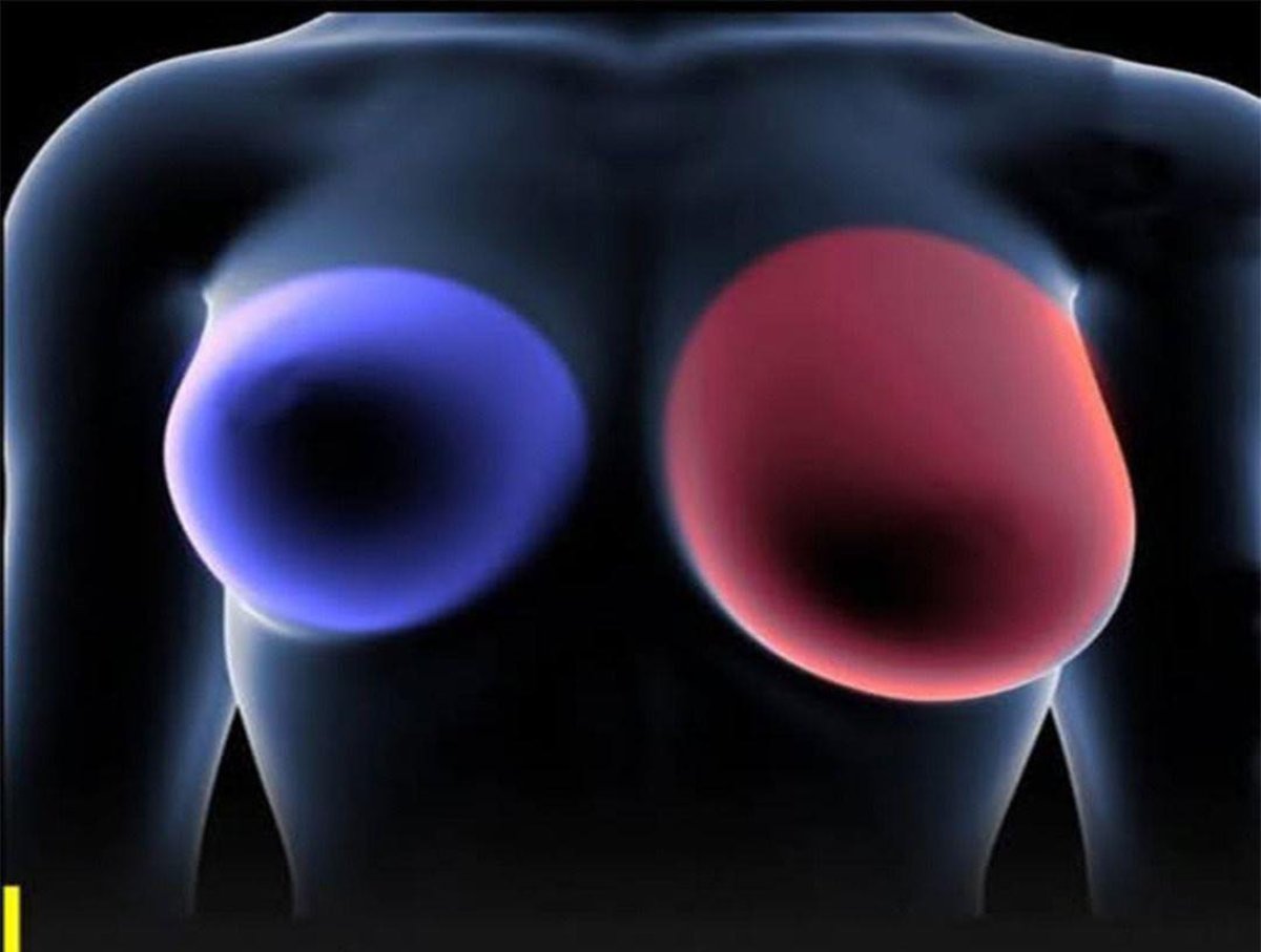 Estos son los síntomas que puedes padecer si tienes cáncer de mama