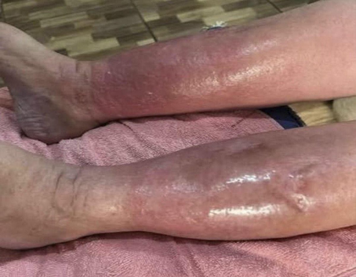 Cómo lidiar con la trombosis venosa profunda: lo que necesitas saber y cómo actuar