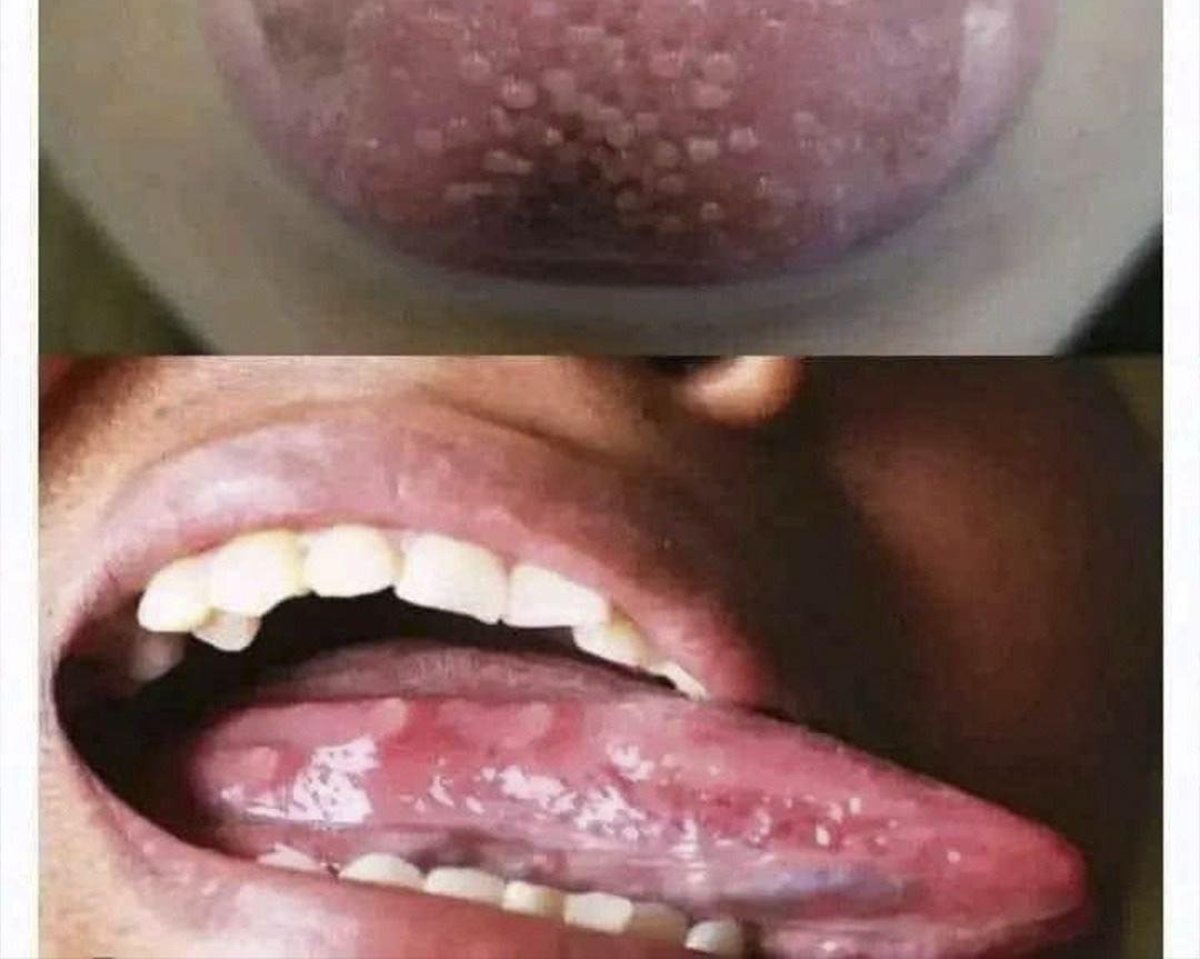 ¿Por qué tengo la lengua blanca? Lo que tu cuerpo quiere decirte