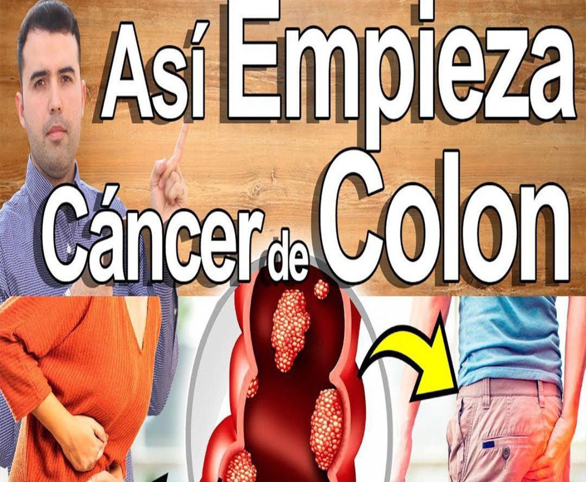 Así empieza el cáncer de colon: las señales silenciosas que muchos ignoran