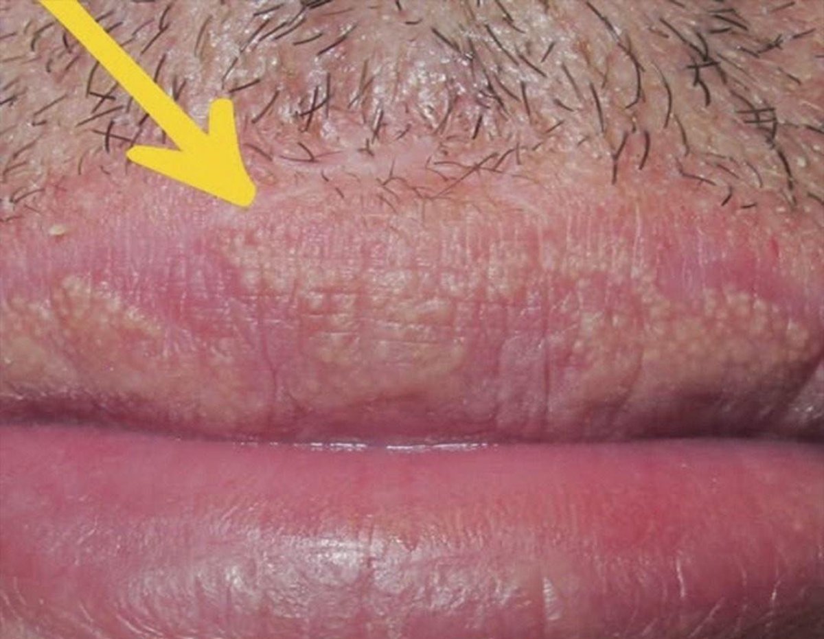 Si te están saliendo estos granitos en tus labios o zona intima