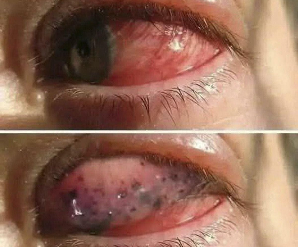 Una infección ocular que no debes ignorar: cómo reconocerla a tiempo y evitar complicaciones