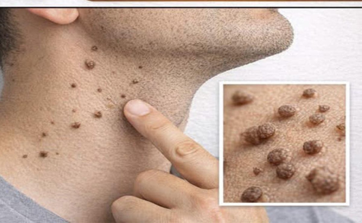 LAS VERRUGAS SE CAEN COMO HOJAS CON SOLO APLICAR ESTE TRATAMIENTO CASERO