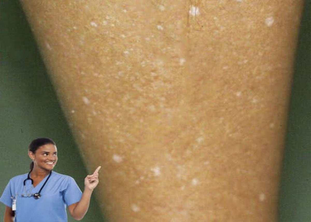 ¿Qué hay detrás de esas manchas blancas en tu piel?