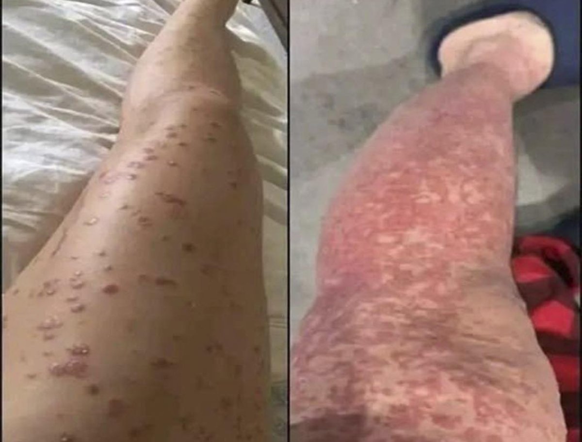 Psoriasis: qué es, por qué aparece y remedios naturales que pueden aliviarla